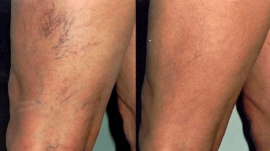 Spider Vein Removal Before and After: What Results Can You Expect?
