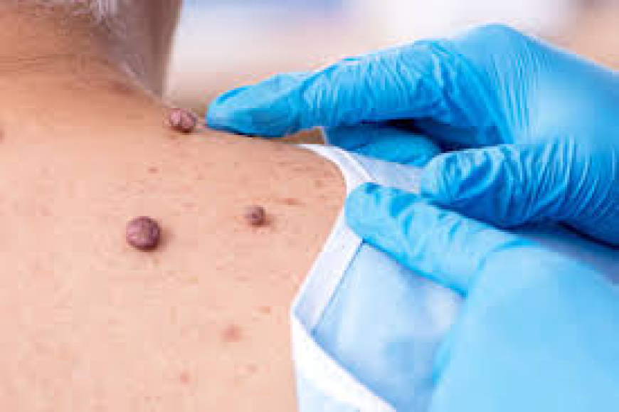 Mole Removal in Dubai: Procedures, Healing & Expert Care | Tajmeels Clinic