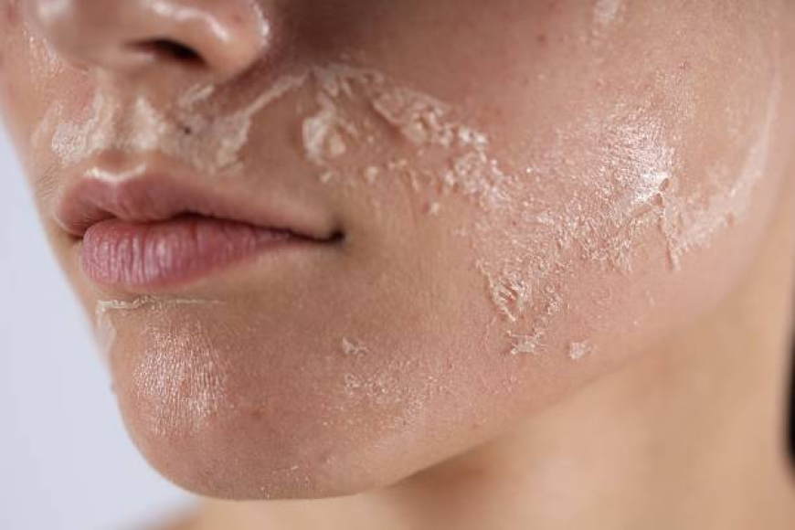 Inno Peeling in Dubai: Long-Term Maintenance and Results
