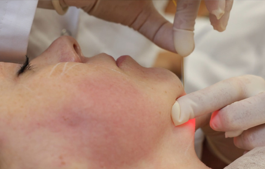 Is Endolift Treatment in Dubai the Ultimate Fix for Sagging Skin