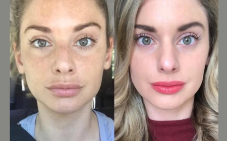 The Complete Experience of Best Plastic Surgeons in Dubai Radiofrequency (RF) Microneedling