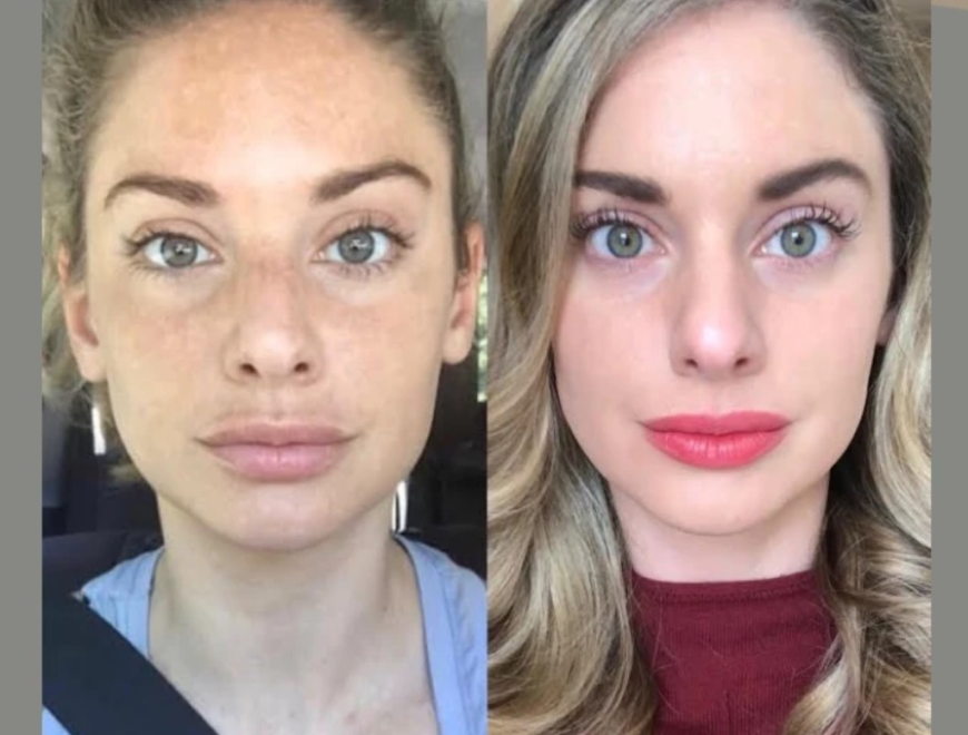 The Complete Experience of Best Plastic Surgeons in Dubai Radiofrequency (RF) Microneedling