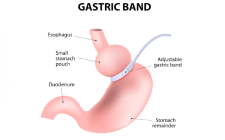 Gastric Banding Cost in Islamabad