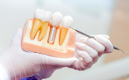 Discover Expert Implant Dentistry Services: Transform Your Smile with Titanium Implants