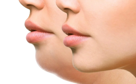 Double Chin Liposuction in Islamabad for Natural-Looking Results