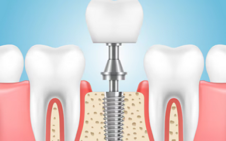 A Tooth That Feels Like Your Own: The Complete Guide to Dental Implants