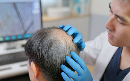 Beard and Mustache Hair Transplant in Dubai Guide
