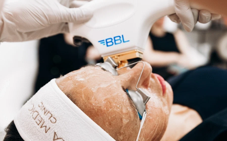 BBL Laser In Manchester – Advanced Skin Rejuvenation Treatment
