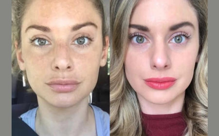 How Best Plastic Surgeons in Dubai Radiofrequency (RF) Microneedling Improves Skin Texture