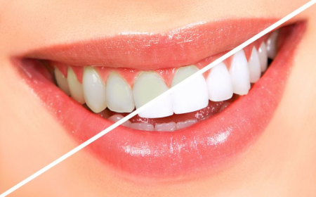 Professional Teeth Whitening in Moss Point MS for Stunning Results