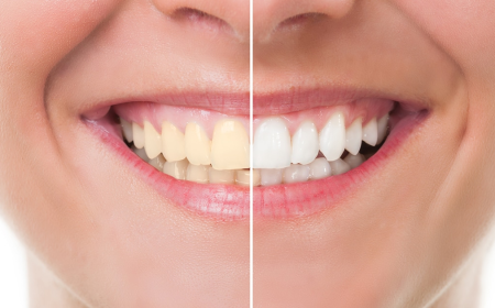 Teeth Whitening Longview TX: Brighten Your Smile with Professional Care