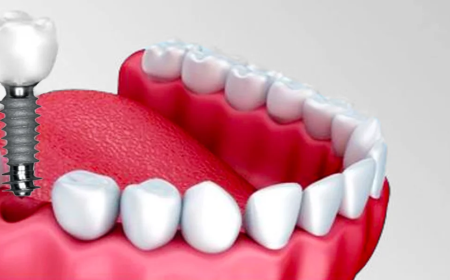 Dental Implants Cantonment FL: A Permanent Solution for Missing Teeth