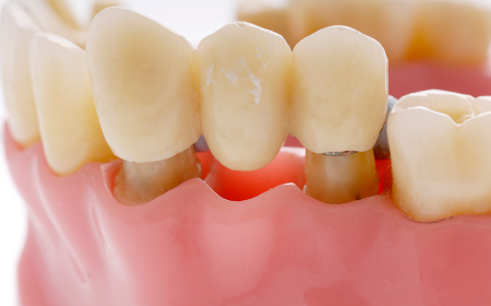 Fixed dental bridges designed for everyday comfort