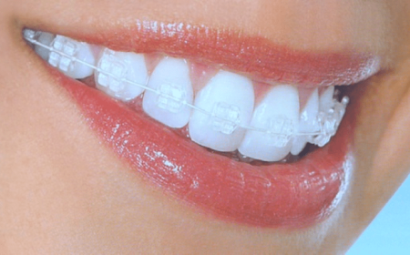 Get aligned teeth with clear braces