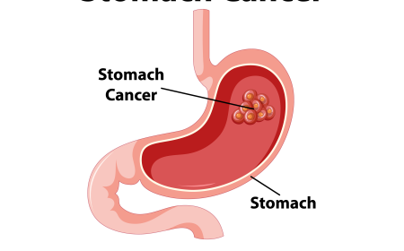 Stomach Cancer Treatment in Delhi: Early Detection and Effective Management