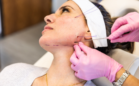 Thread Lift in London vs Dermal Fillers: Which Treatment Gives Better Contouring?