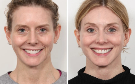 Thread Lift Treatments in Dubai: Myths vs Facts