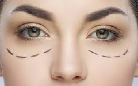 Everything You Need to Know About Lower Blepharoplasty in London