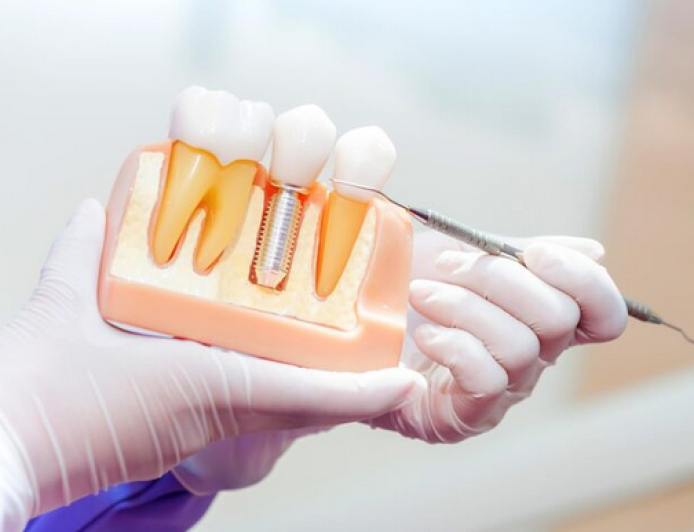 Discover Expert Implant Dentistry Services: Transform Your Smile with Titanium Implants