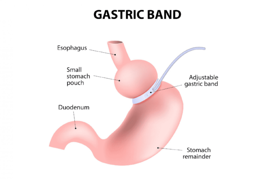 Gastric Banding Cost in Islamabad