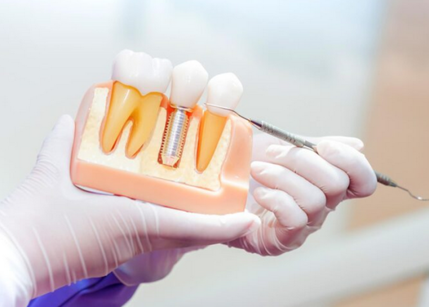 Discover Expert Implant Dentistry Services: Transform Your Smile with Titanium Implants