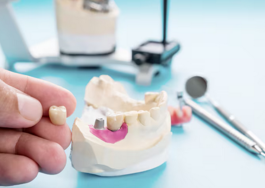 Dental Bridges the Gap: Restore Chewing Function