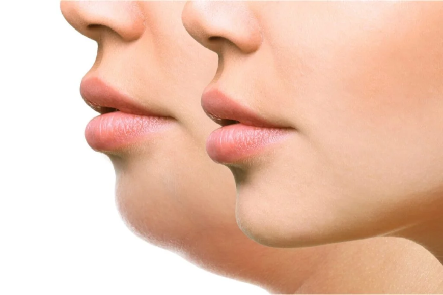 Double Chin Liposuction in Islamabad for Natural-Looking Results