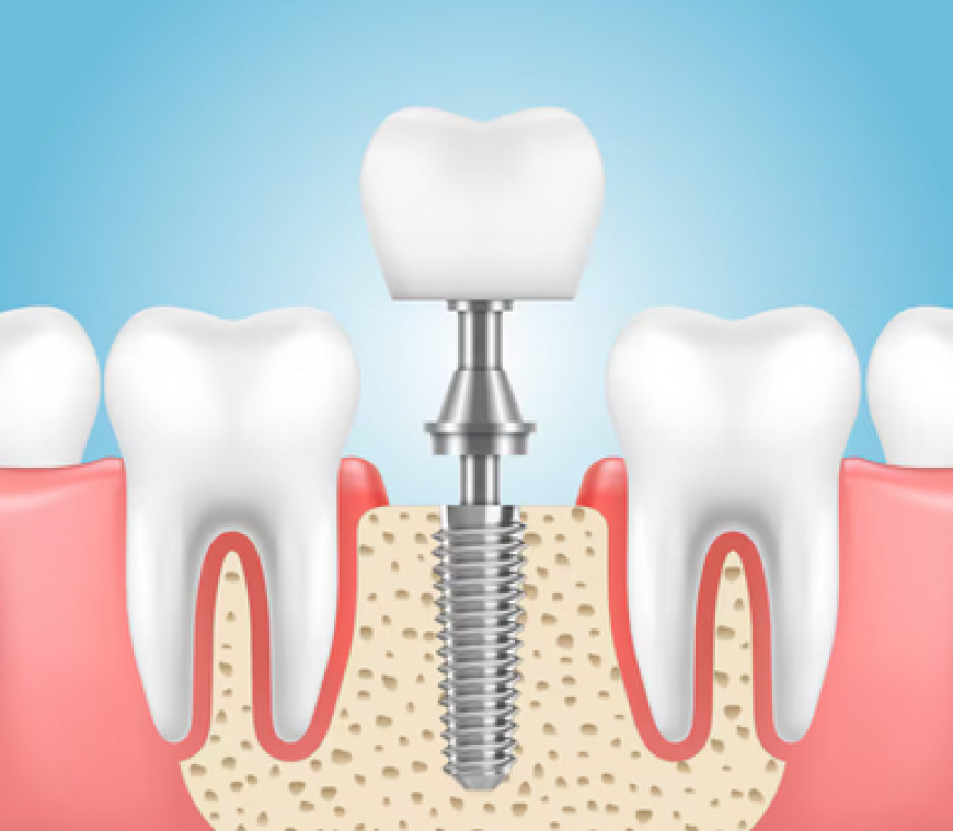 A Tooth That Feels Like Your Own: The Complete Guide to Dental Implants