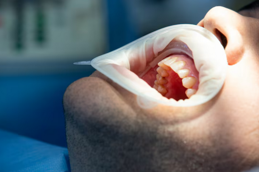 Restorative and Cosmetic Solutions: Unveiling the Benefits of Full Mouth Restoration