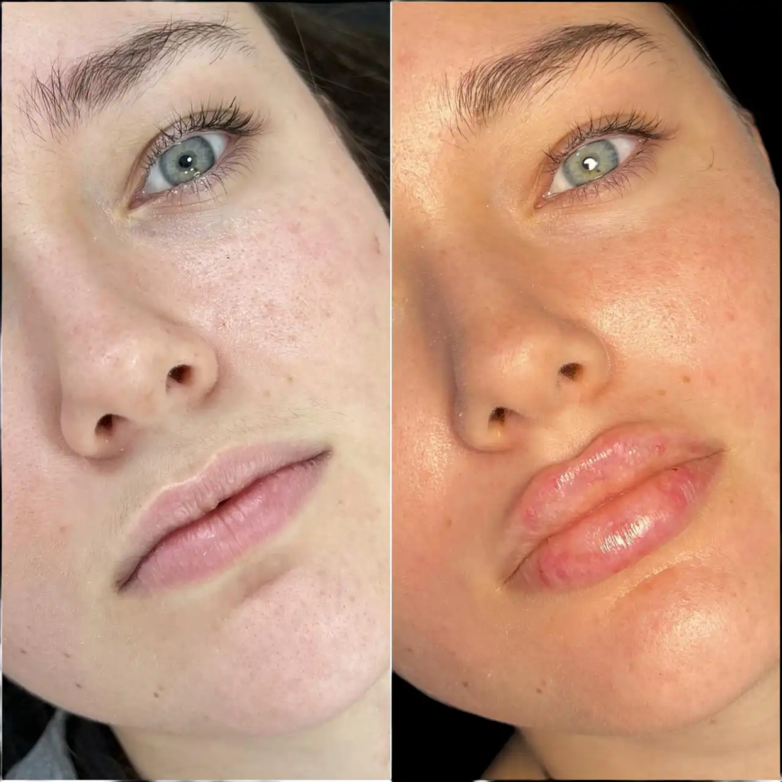 Best Doctors in dubai for High-Quality Fillers Results