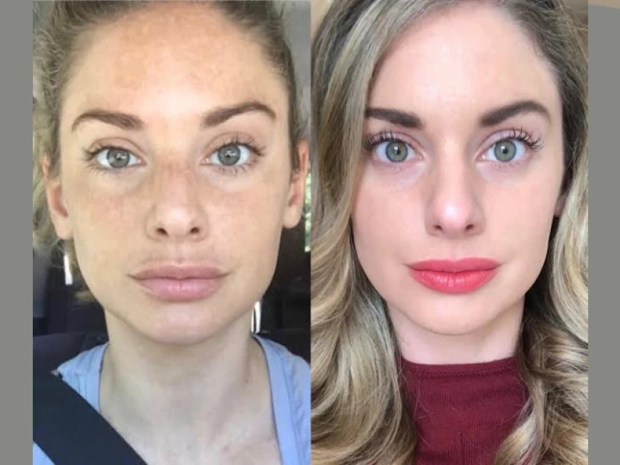 How Best Plastic Surgeons in Dubai Radiofrequency (RF) Microneedling Improves Skin Texture