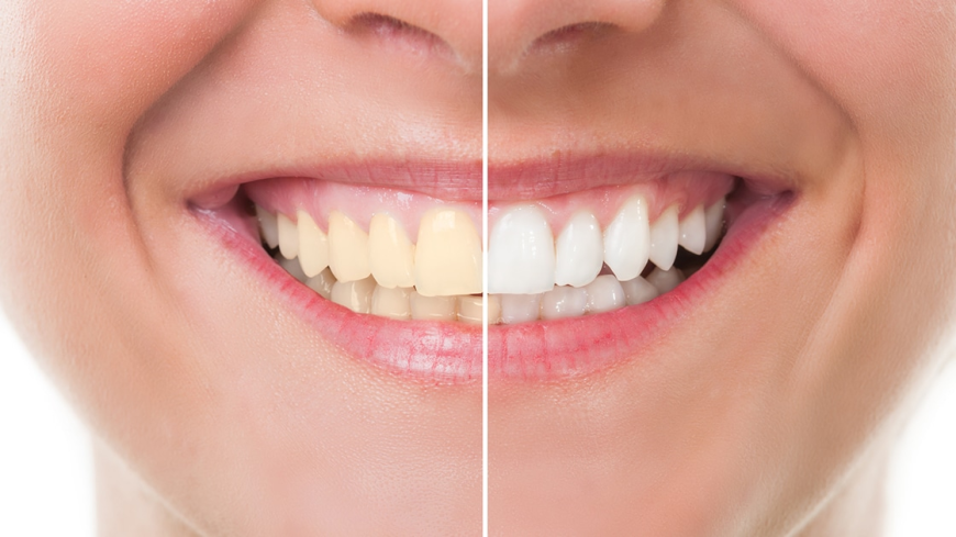 Teeth Whitening Longview TX: Brighten Your Smile with Professional Care