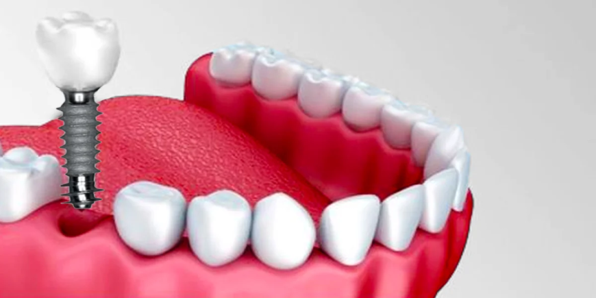 Dental Implants Cantonment FL: A Permanent Solution for Missing Teeth