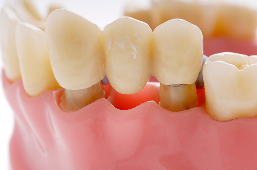 Fixed dental bridges designed for everyday comfort