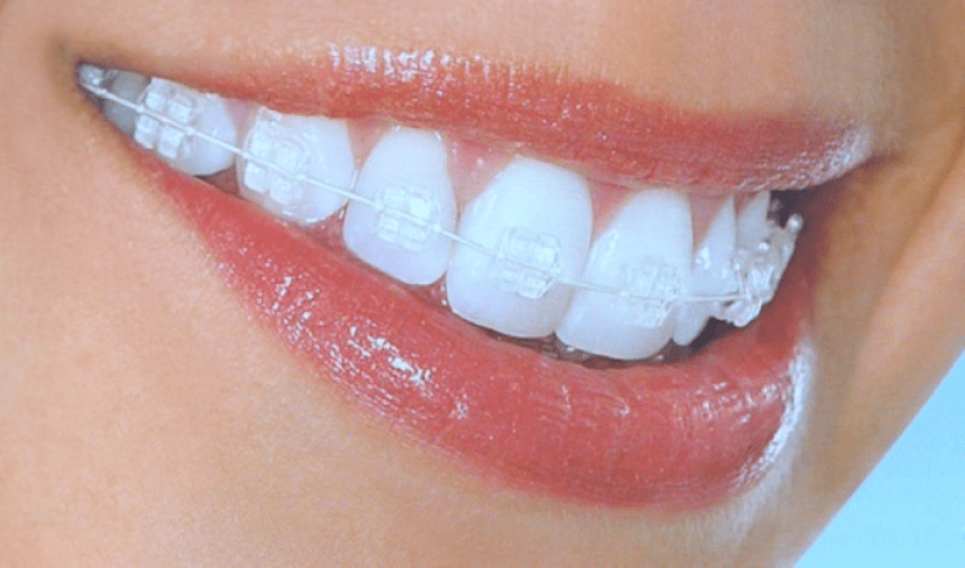Get aligned teeth with clear braces