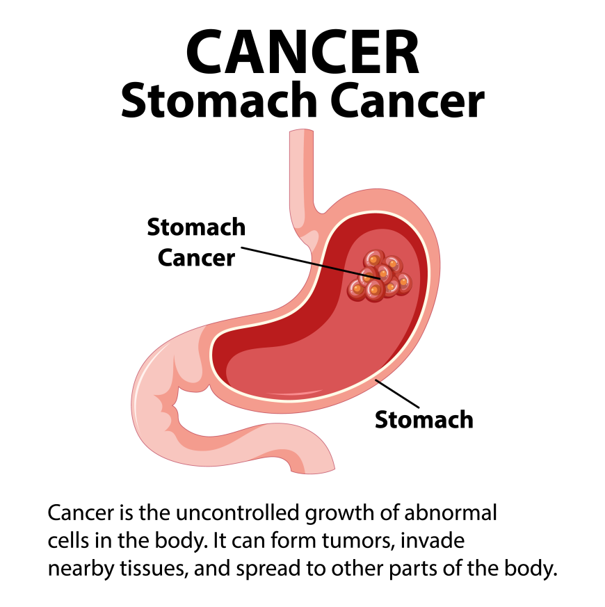 Stomach Cancer Treatment in Delhi: Early Detection and Effective Management