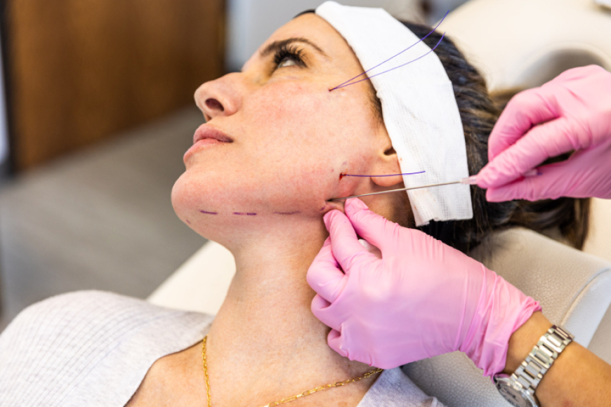 Thread Lift in London vs Dermal Fillers: Which Treatment Gives Better Contouring?