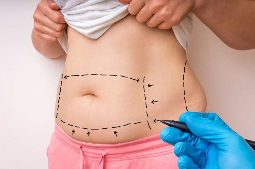 Why Dubai Is a Popular Destination for Mommy Makeover Surgery