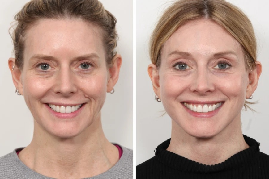 Thread Lift Treatments in Dubai: Myths vs Facts