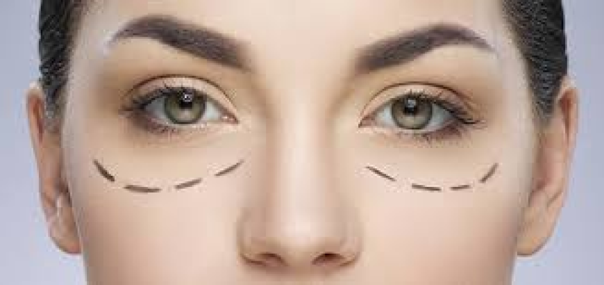 Everything You Need to Know About Lower Blepharoplasty in London
