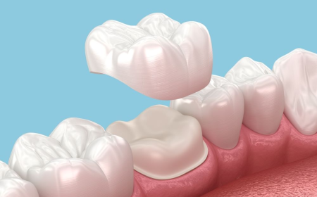 Choosing the Best Dentist for Dental Crown Dubai
