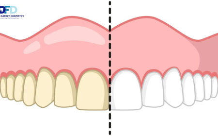 Teeth Whitening Sensitivity: Is It Permanent? | Bryn Mawr