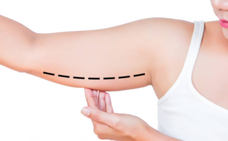 Best Arm Lift Surgery in Dubai for Firmer Upper Arms