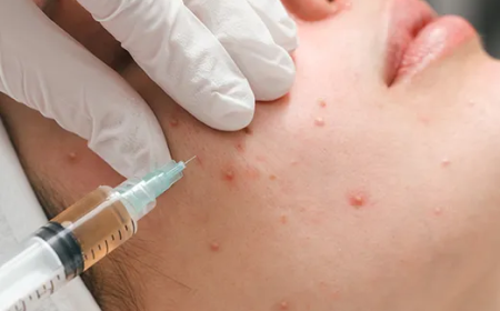 How Acne Treatment In Dubai Helps Reduce Acne Marks
