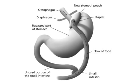 How Much Weight Can You Lose After Gastric Bypass?