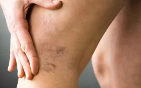 Varicose Veins Treatment In Dubai – Advanced Solutions for Smoother, Healthier-Looking Legs