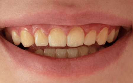 Teeth Whitening in Bryn Mawr | Dillon Family Dentistry