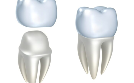 Dental Crowns Cost: What You Can Expect to Pay in 2026