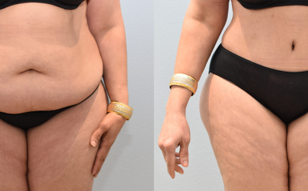 Why Modern Body Sculpting Begins With Understanding Individual Anatomy
