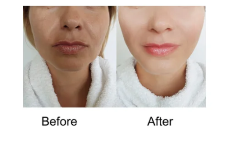 Bio Rae Whitening Injection: A Trusted Choice for Skin Brightening in Pakistan